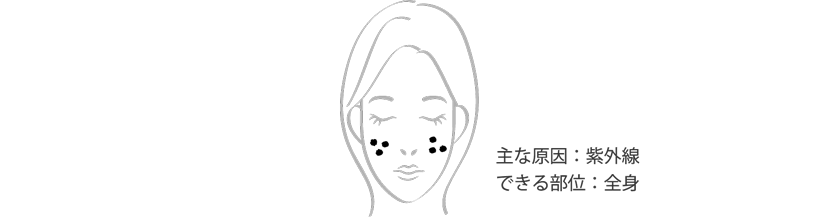 日光性黒子