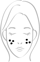 日光性黒子